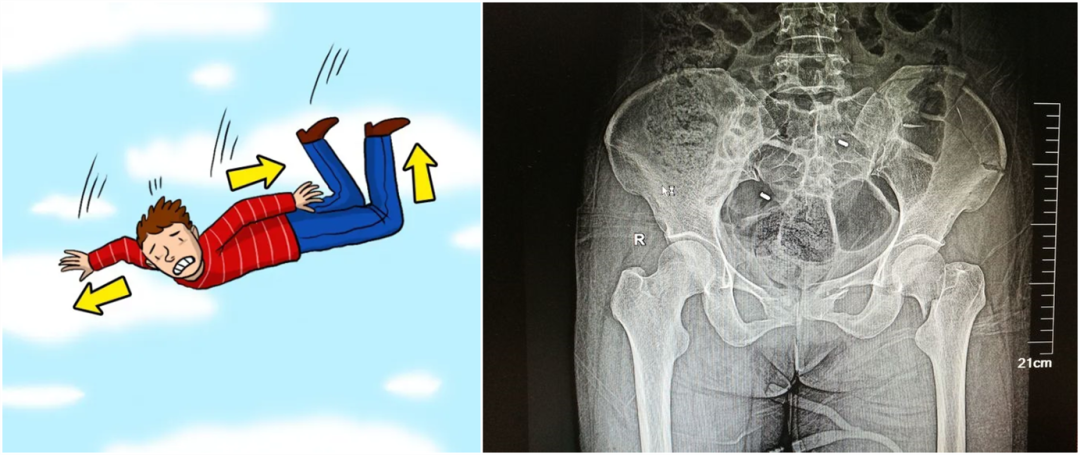 【醫(yī)療科普】：外傷性骨折影像