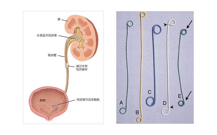 輸尿管支架工作原理及常見(jiàn)的雙J管