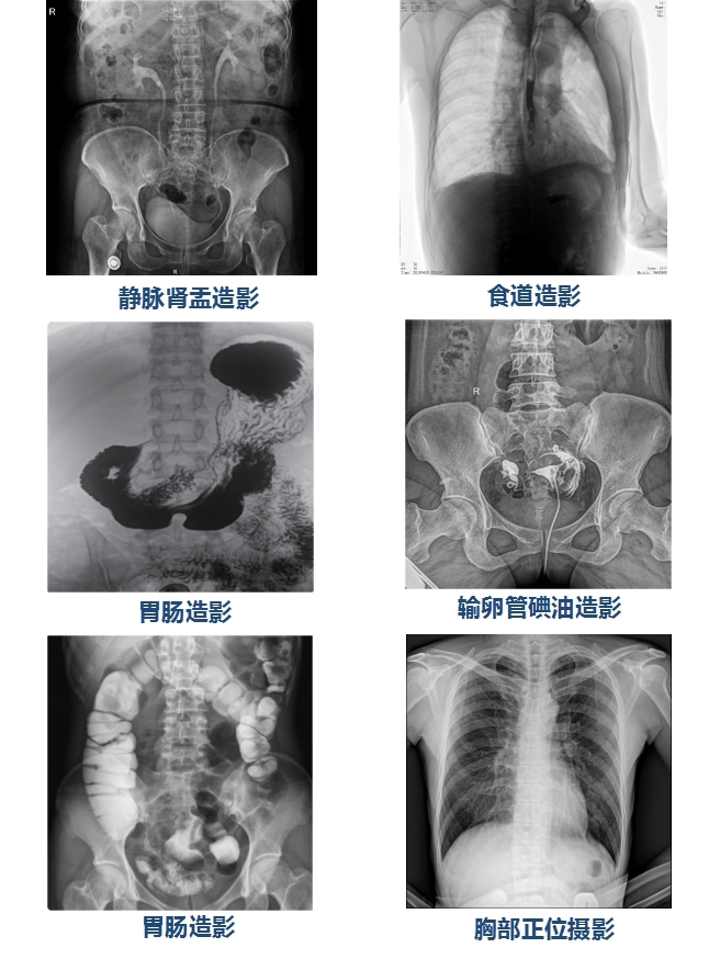 85kW大功率u臂平板dr機(jī)PLX8500F-500μ臨床圖像