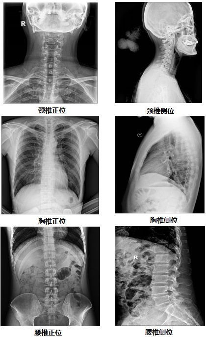 國(guó)產(chǎn)無(wú)線懸吊dr部分臨床效果圖