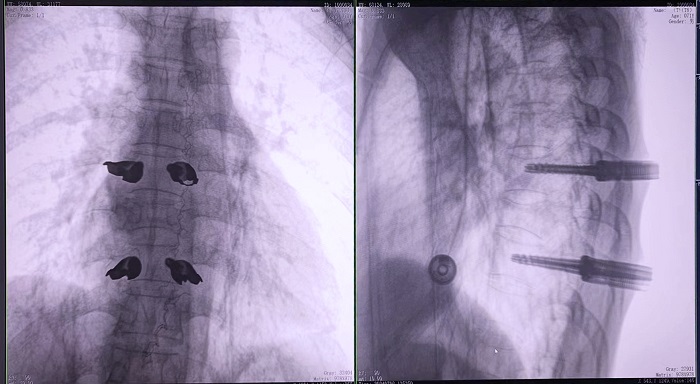 機(jī)器人做胸椎置釘手術(shù)